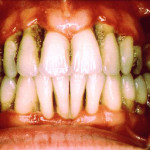 Gum-Disease
